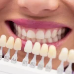 Transform your smiles with veneers!