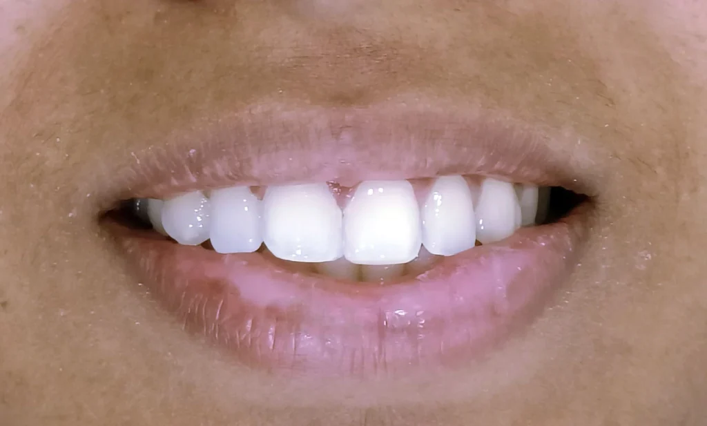 patient-after-veneer