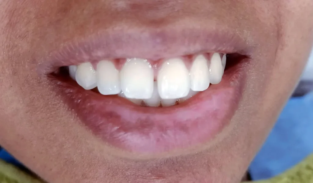 patient-teeth-before-veneer