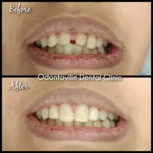 Treating the patient with Dental Veneers