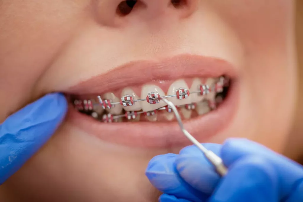 woman-with-metal-braces-for-teeth-alignment