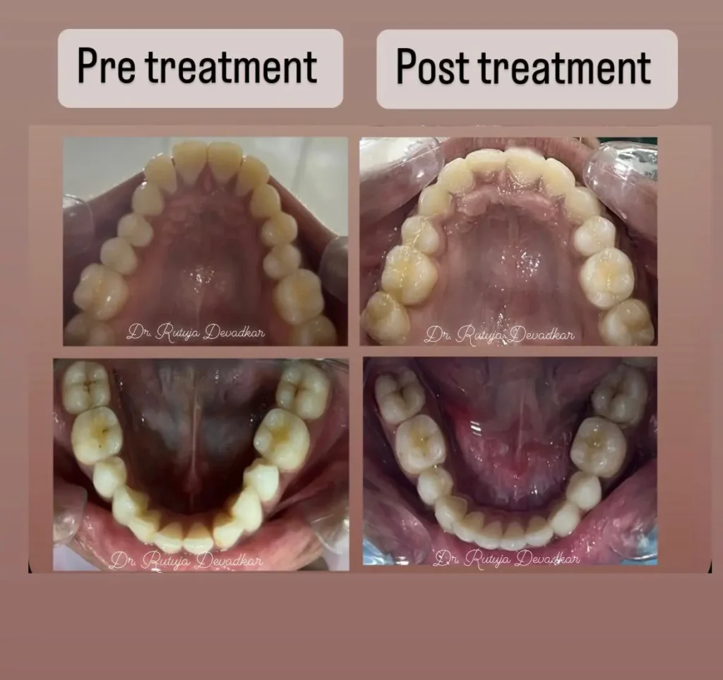 finding the cause of protrusion. descriptive image