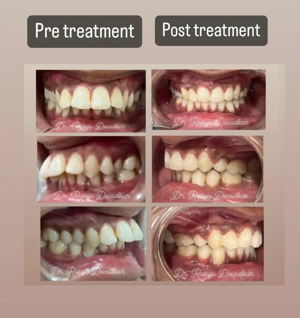 pre-post treatment of bimaxillary protrusion. Explanatory image