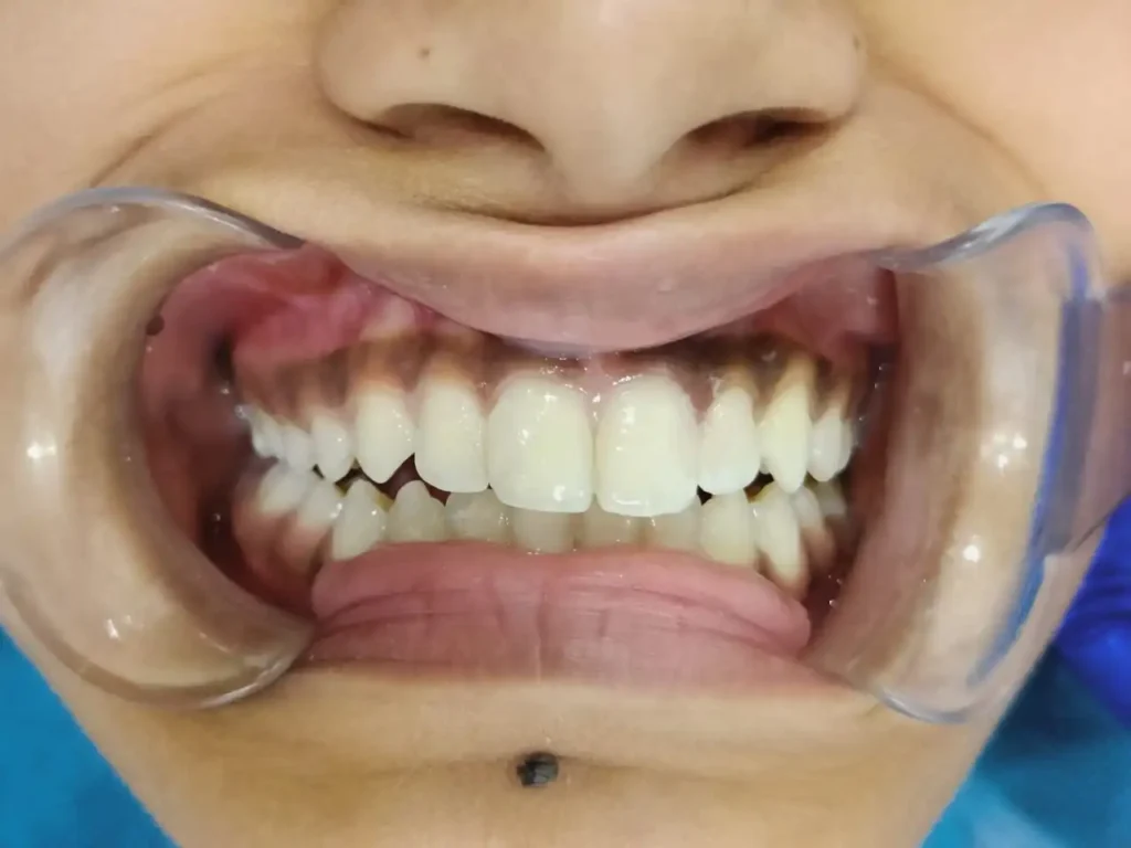 teeth-restored-composite-filling