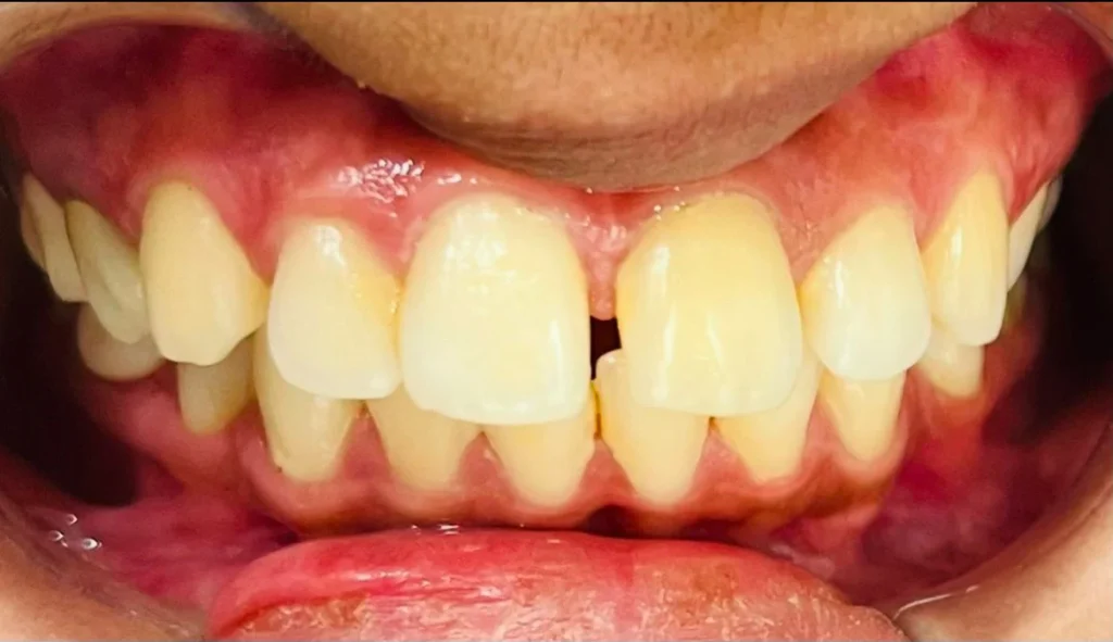 before-treatment