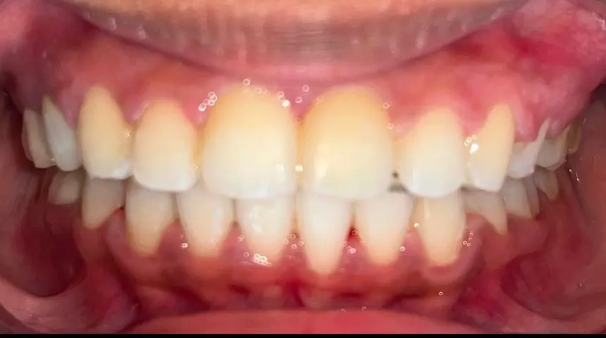 closed-gap-after-treatment