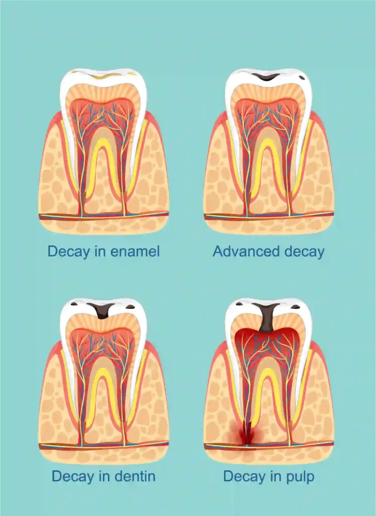 tooth-decay-never-delay-a-dental-visit