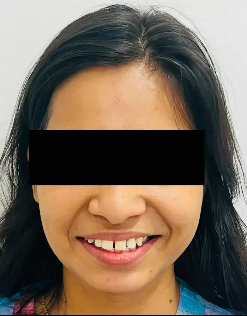 initial-gap-before-treatment