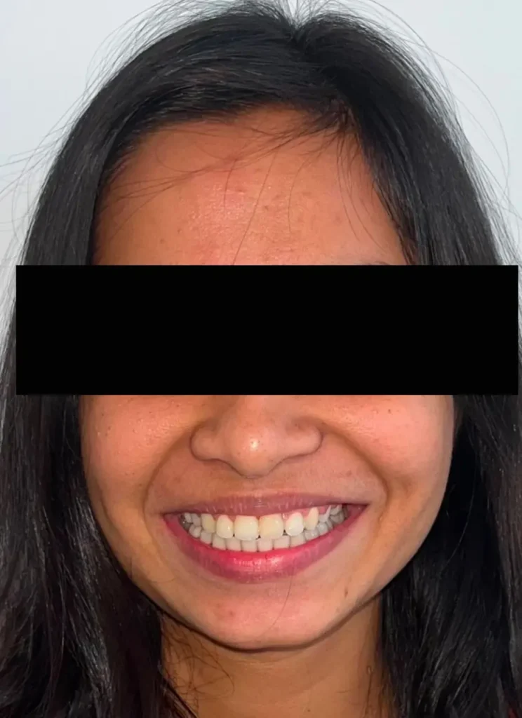 after-braces-treatment